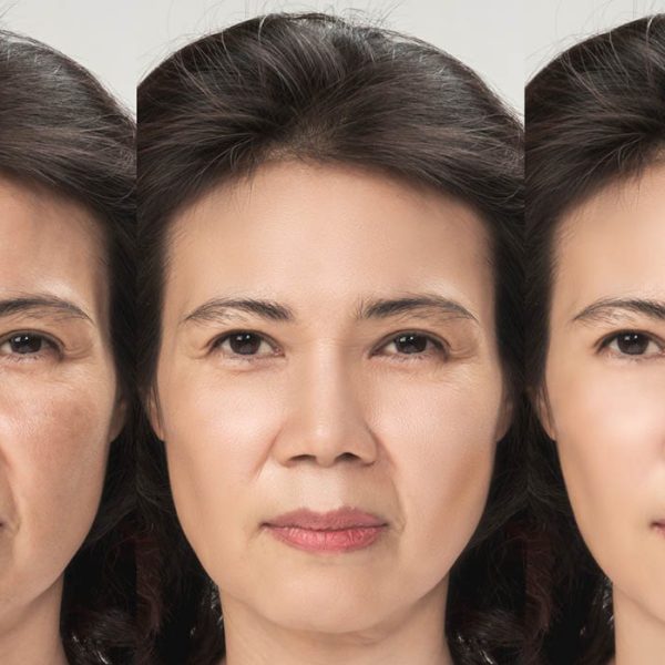HIFU Facelift Longevity: How Long Results Last and How to Maintain Them