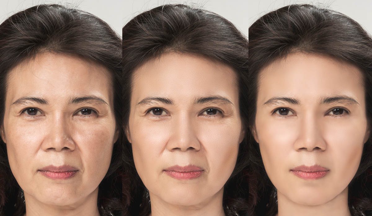 HIFU Facelift Longevity: How Long Results Last and How to Maintain Them